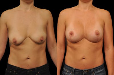 Breast Lift with Augmentation Before & After Gallery - Patient 197931 - Image 1