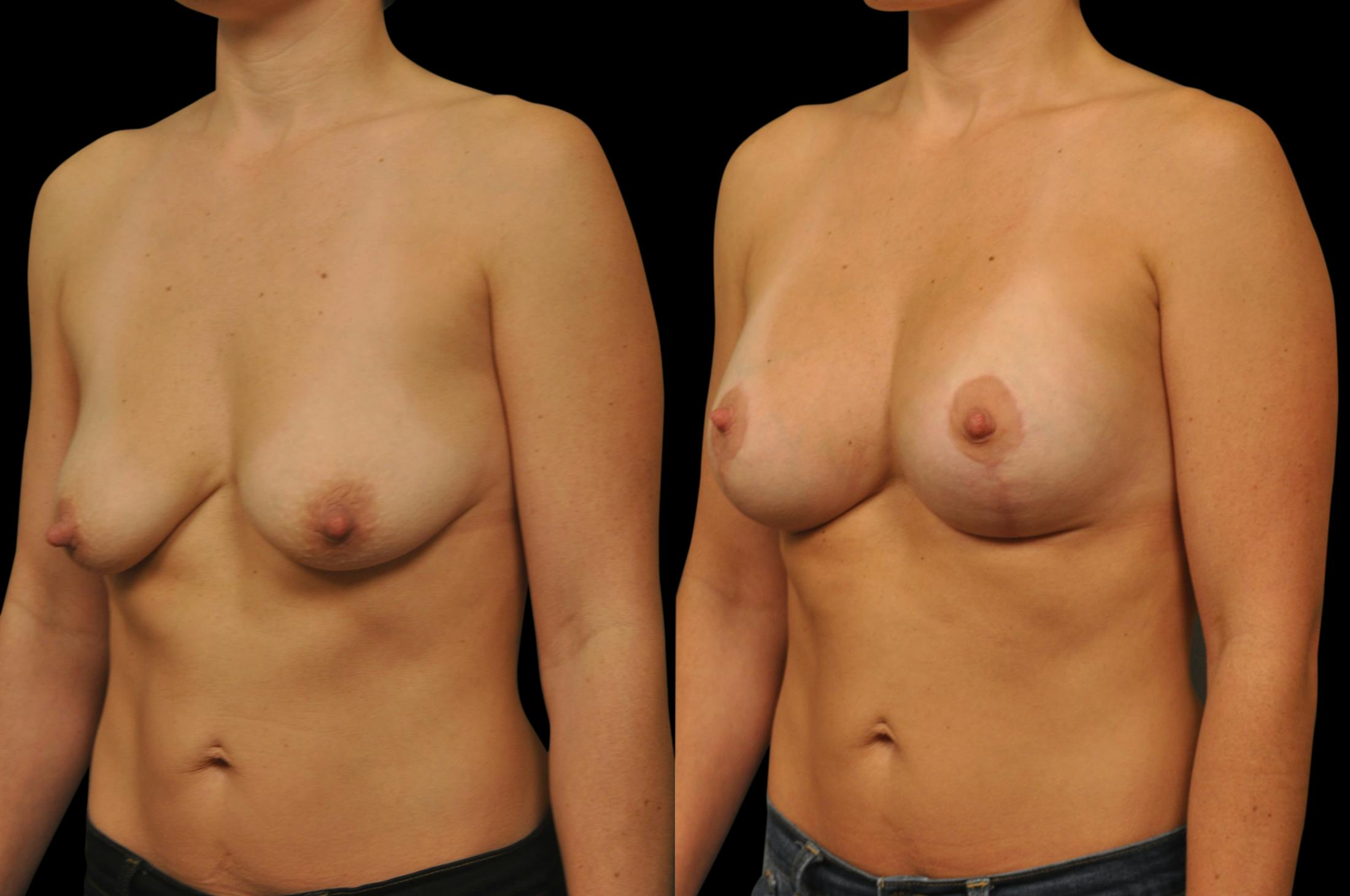 Breast Lift Before & After Gallery - Patient 439908 - Image 2