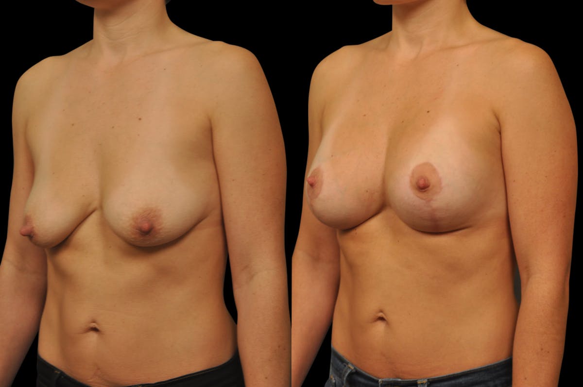 Breast Lift with Augmentation Before & After Gallery - Patient 197931 - Image 2
