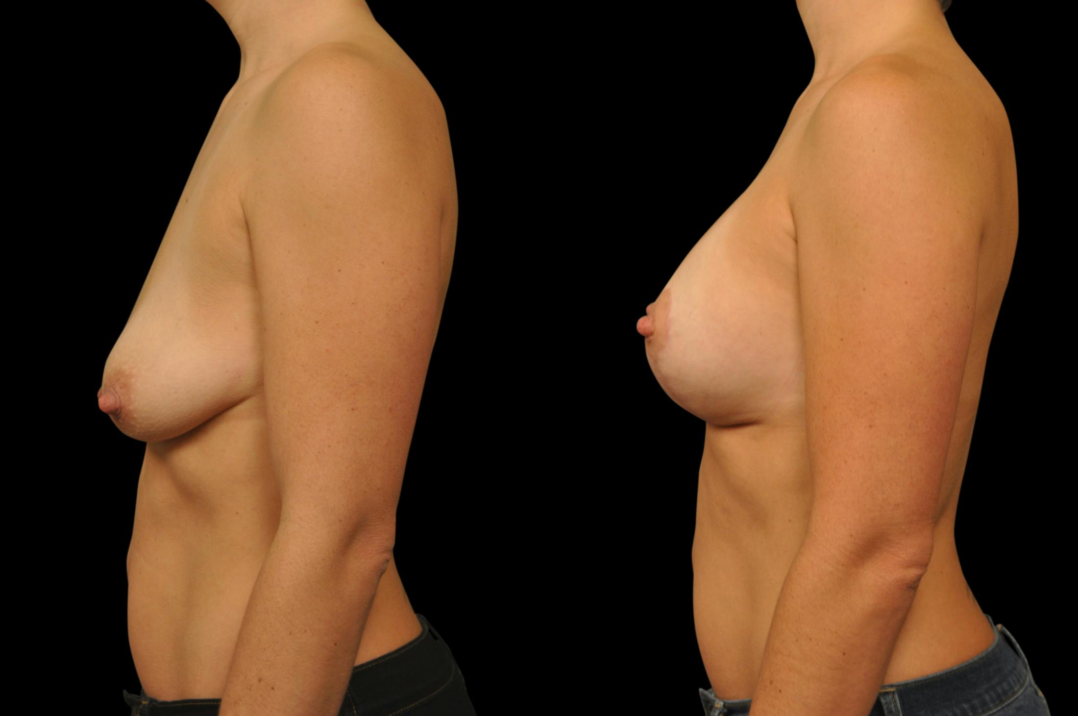 Breast Lift Before & After Gallery - Patient 439908 - Image 3