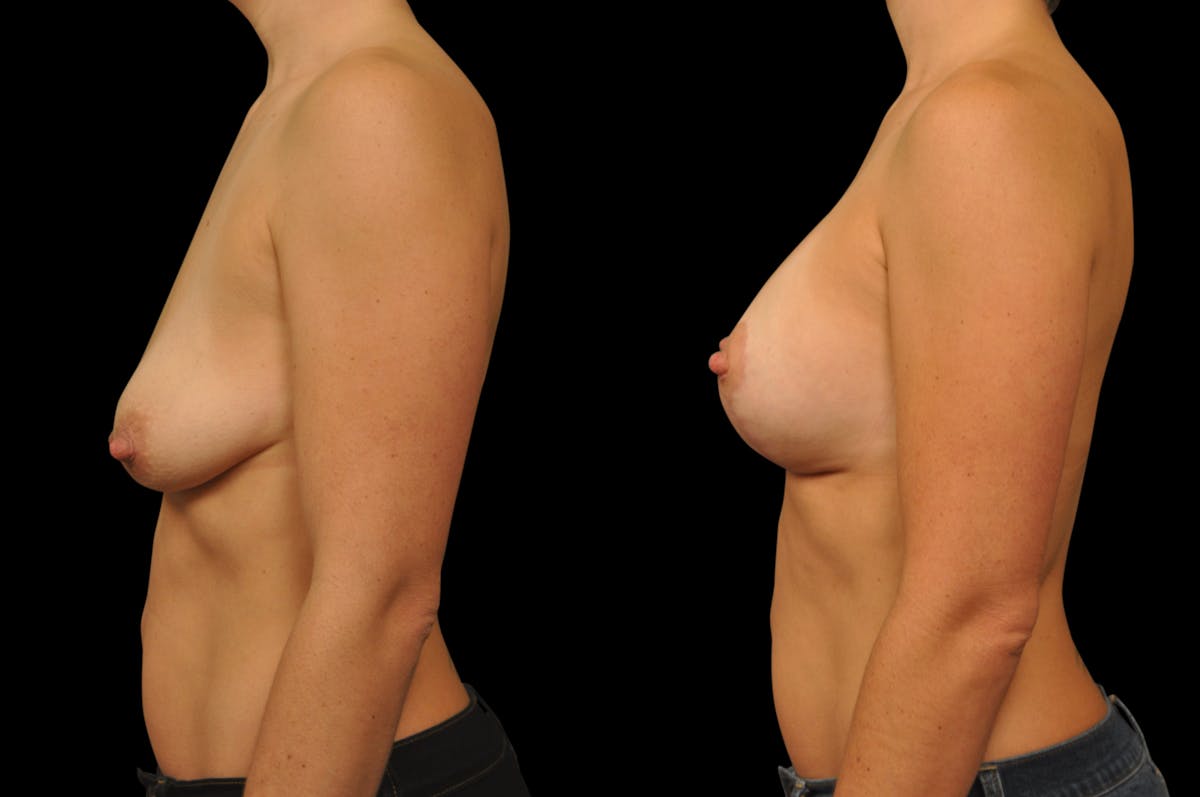 Breast Lift with Augmentation Before & After Gallery - Patient 197931 - Image 3