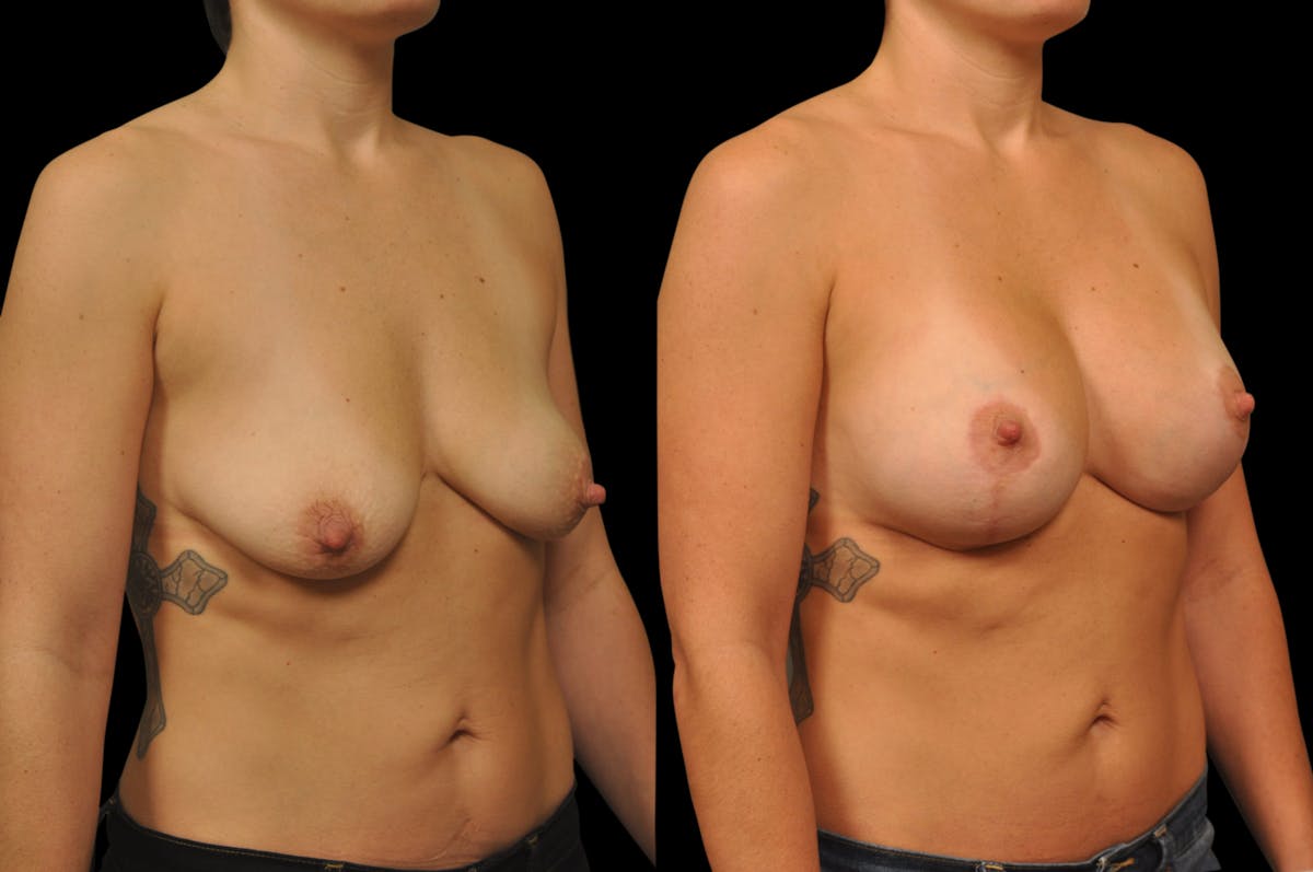Breast Lift with Augmentation Before & After Gallery - Patient 197931 - Image 4