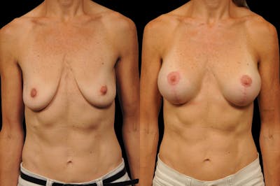 Breast Lift Before & After Gallery - Patient 251282 - Image 1