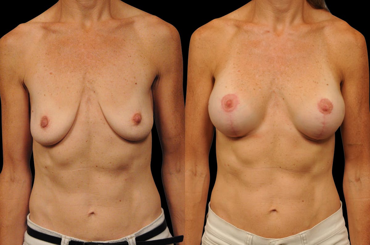 Breast Lift with Augmentation Before & After Gallery - Patient 296320 - Image 1