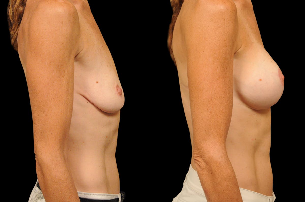Breast Lift with Augmentation Before & After Gallery - Patient 296320 - Image 2