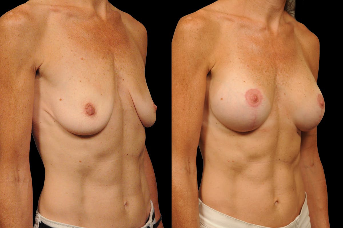 Breast Lift Before & After Gallery - Patient 251282 - Image 3