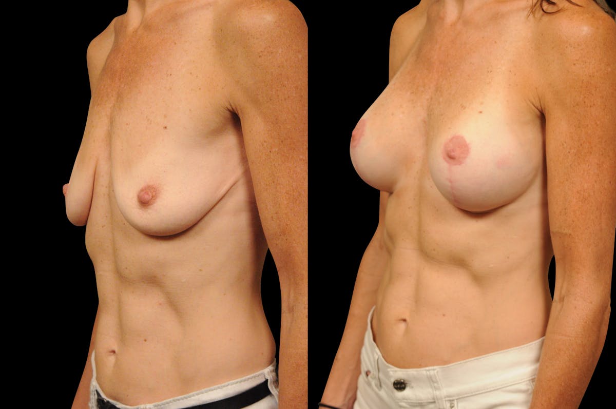 Breast Lift Before & After Gallery - Patient 251282 - Image 5