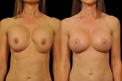 Breast Revision Before & After Gallery - Patient 301444 - Image 1