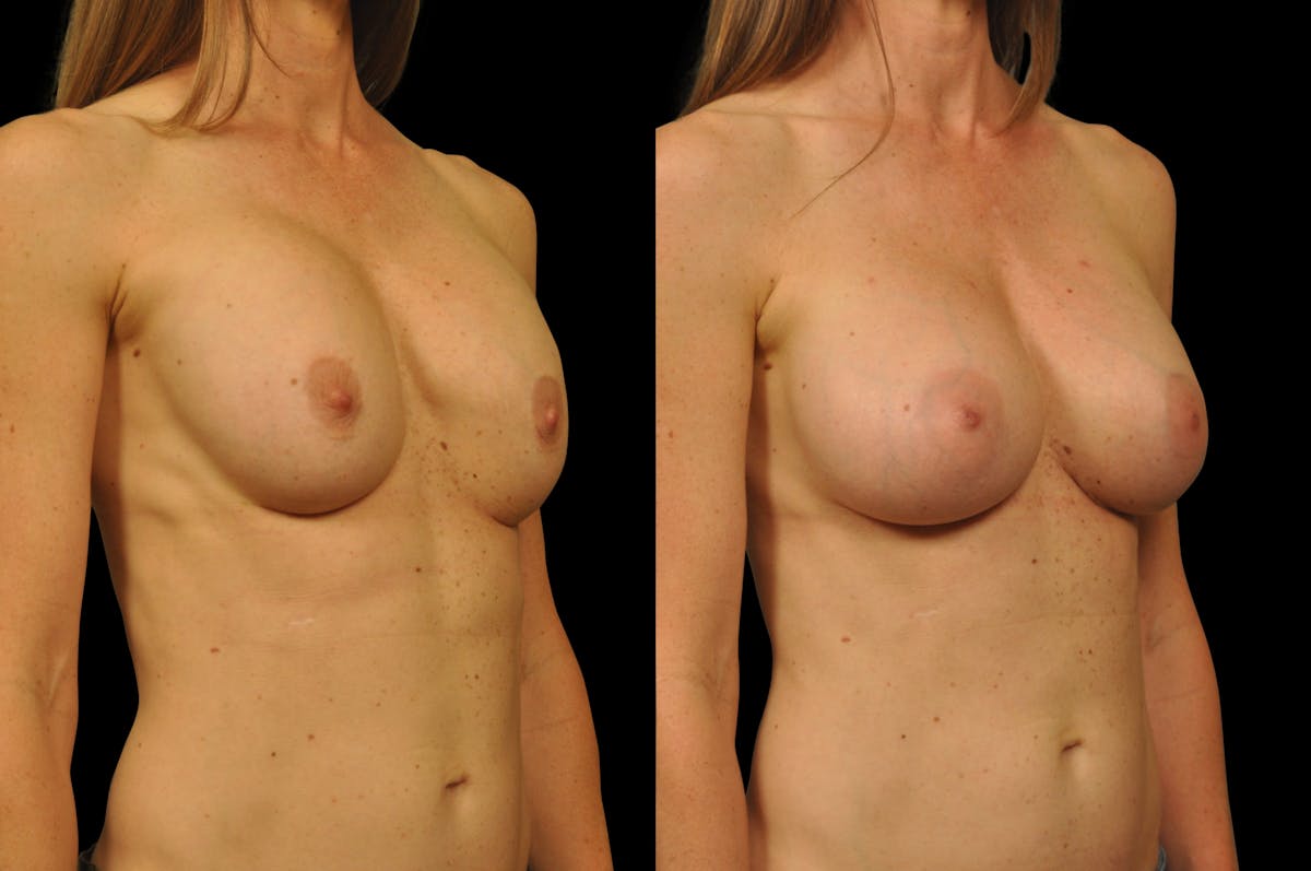 Breast Revision Before & After Gallery - Patient 301444 - Image 2