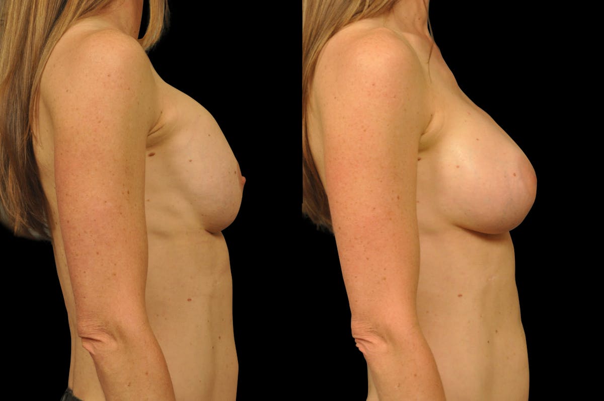Breast Revision Before & After Gallery - Patient 301444 - Image 3
