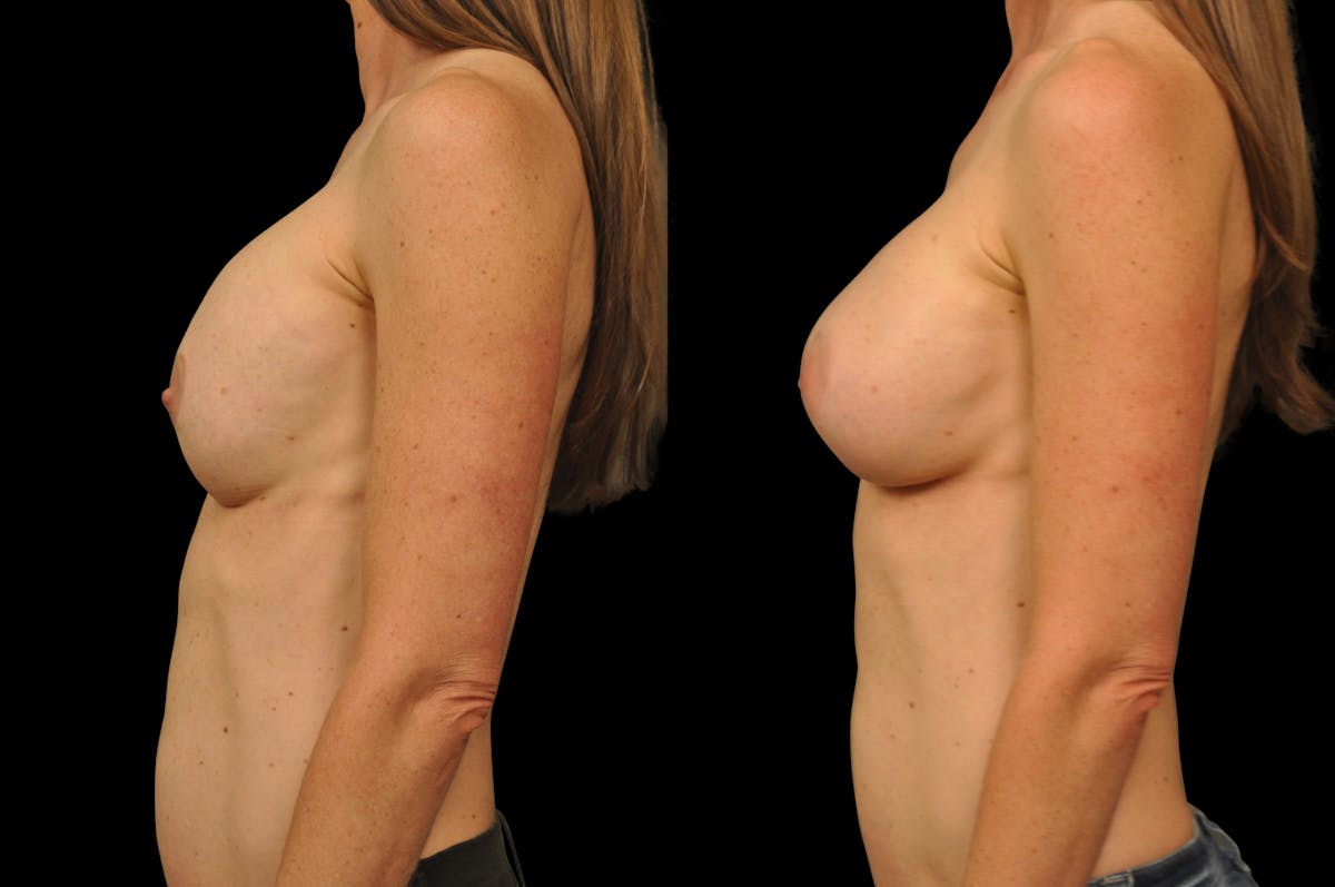 Breast Revision Before & After Gallery - Patient 301444 - Image 5