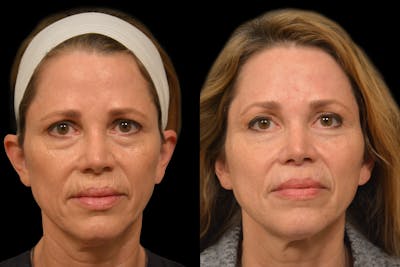 Brow Lift Before & After Gallery - Patient 316527 - Image 1