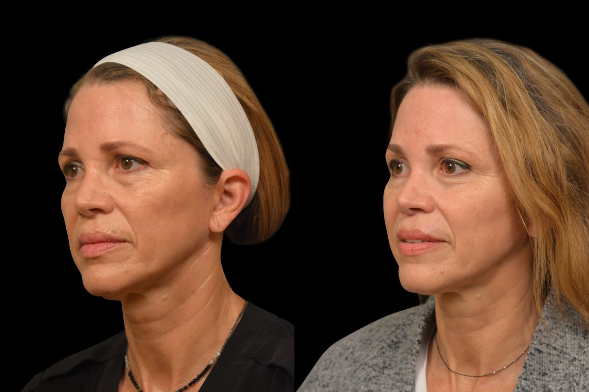 Brow Lift Before & After Gallery - Patient 316527 - Image 2