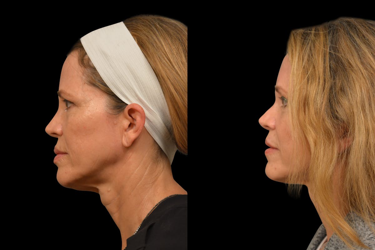 Brow Lift Before & After Gallery - Patient 316527 - Image 3