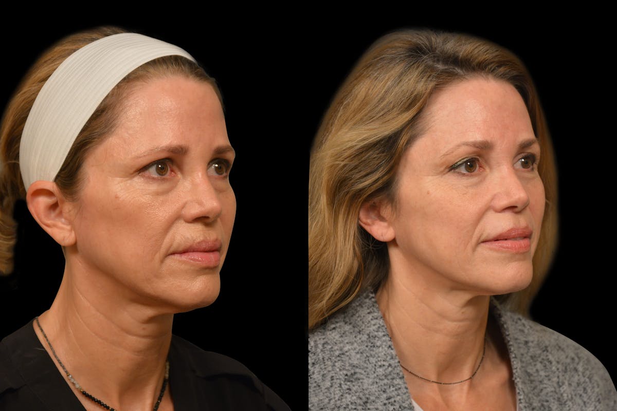 Brow Lift Before & After Gallery - Patient 316527 - Image 4