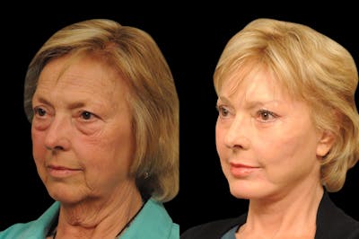 Chin Augmentation Before & After Gallery - Patient 333451 - Image 1