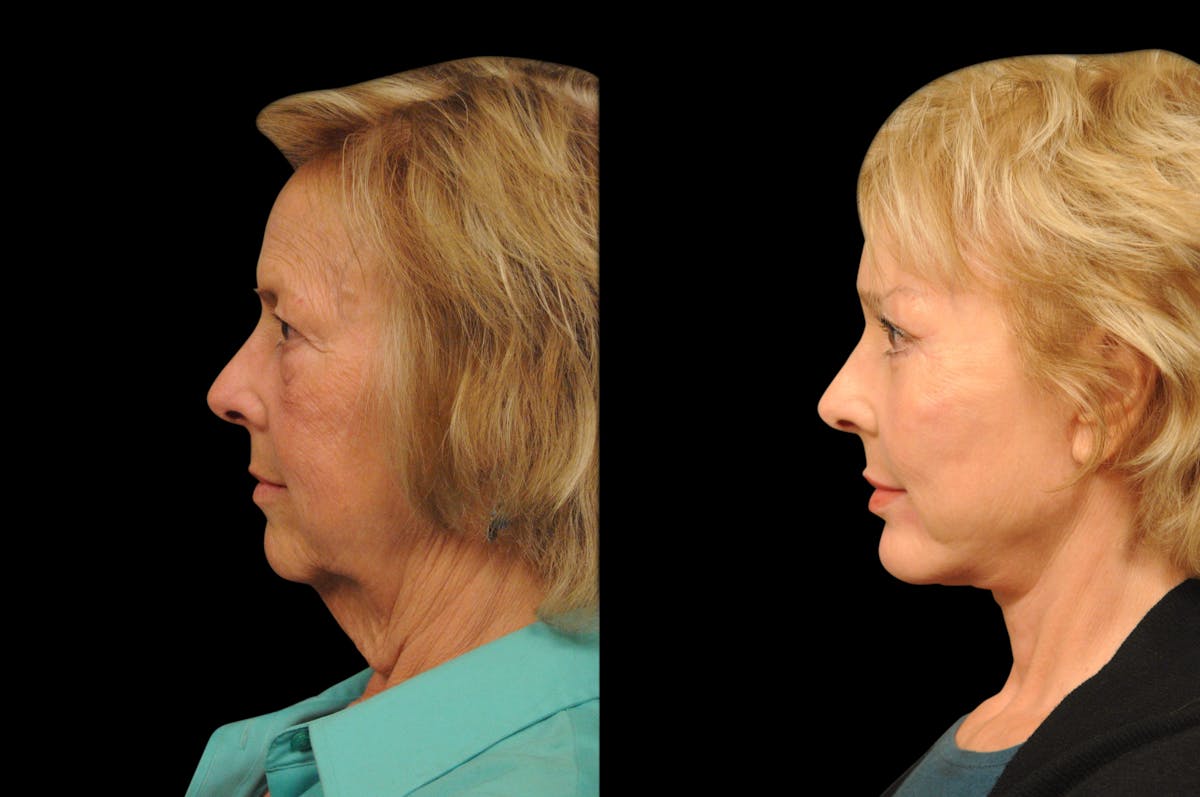 Changes Rapid Lift  Before & After Gallery - Patient 238639 - Image 2