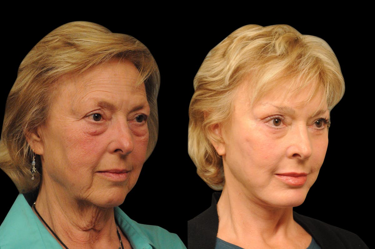 Changes Rapid Lift  Before & After Gallery - Patient 238639 - Image 3