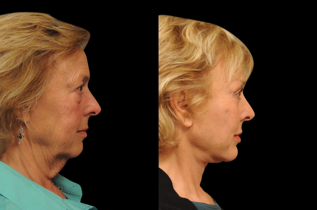 Changes Rapid Lift  Before & After Gallery - Patient 238639 - Image 4