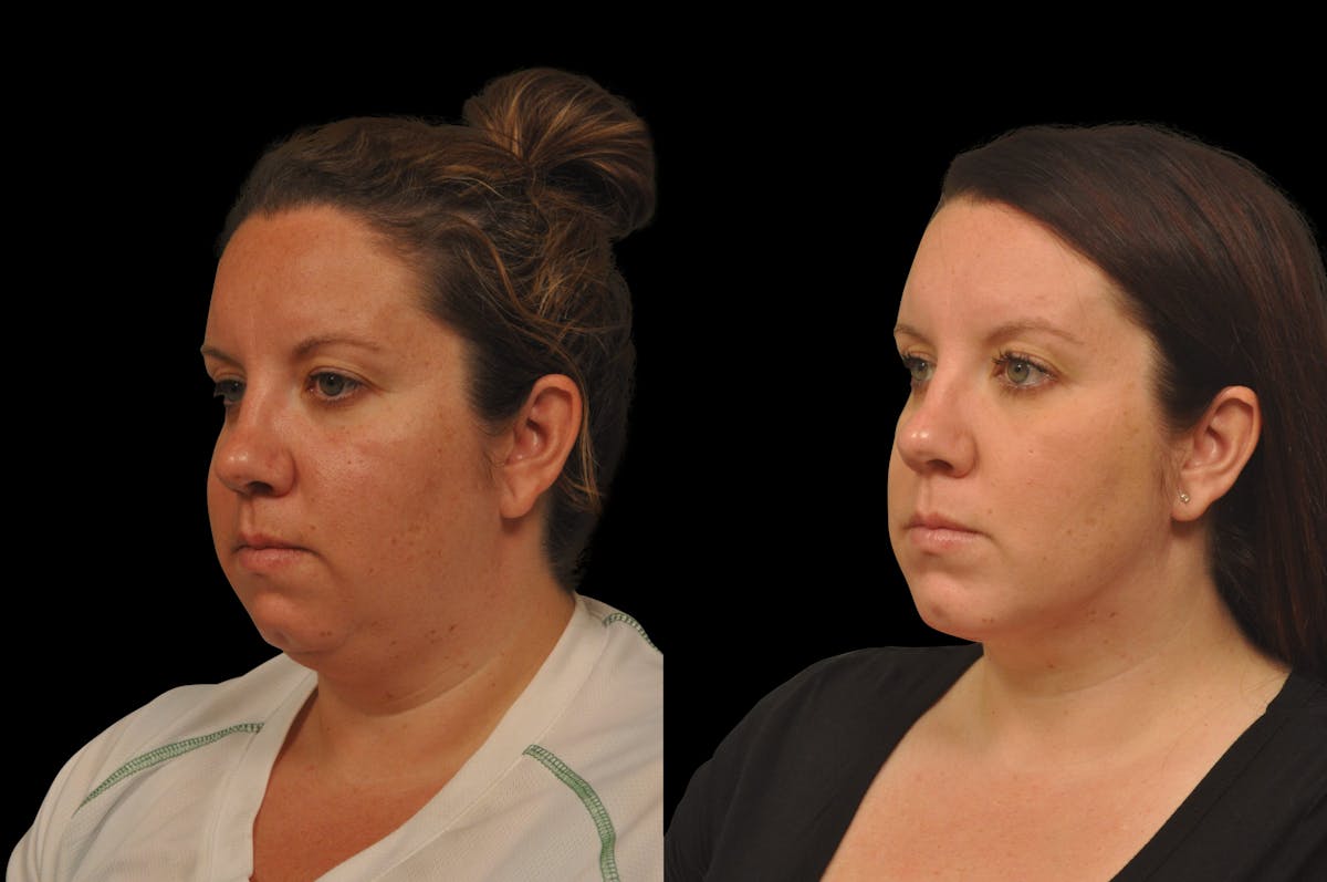 Chin Augmentation Before & After Gallery - Patient 884392 - Image 1