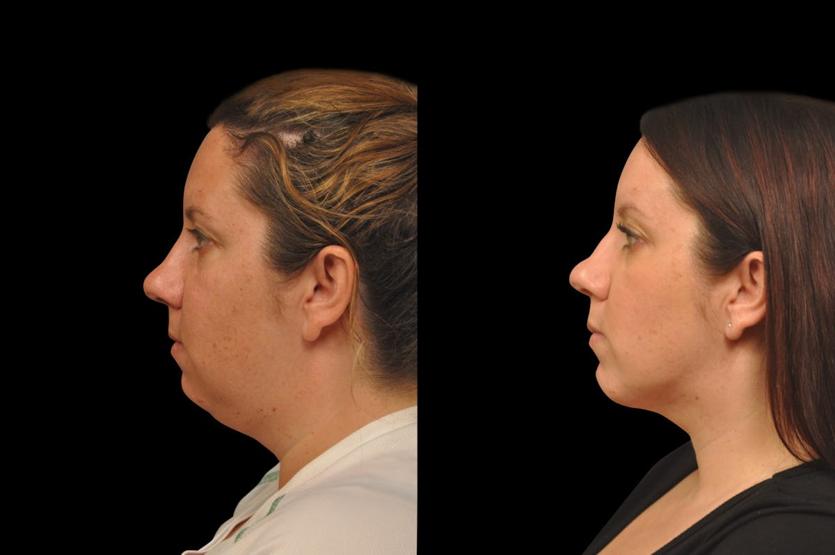 Chin Augmentation Before & After Gallery - Patient 884392 - Image 2