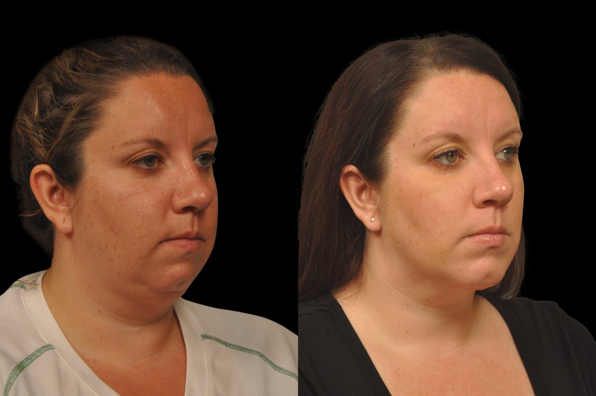 Chin Augmentation Before & After Gallery - Patient 884392 - Image 3