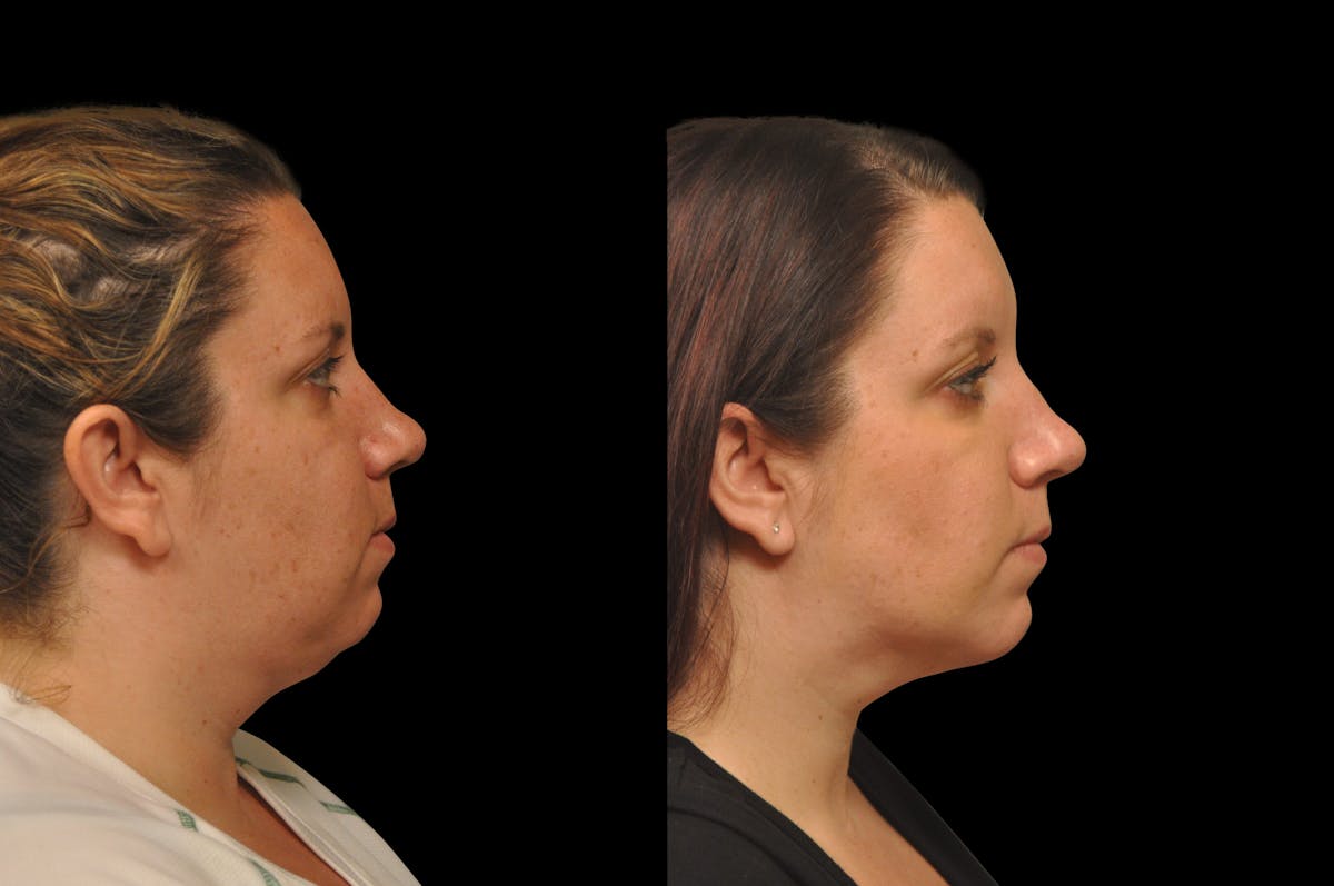Chin Augmentation Before & After Gallery - Patient 884392 - Image 4