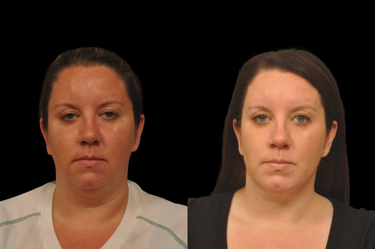Chin Augmentation Before & After Gallery - Patient 884392 - Image 5
