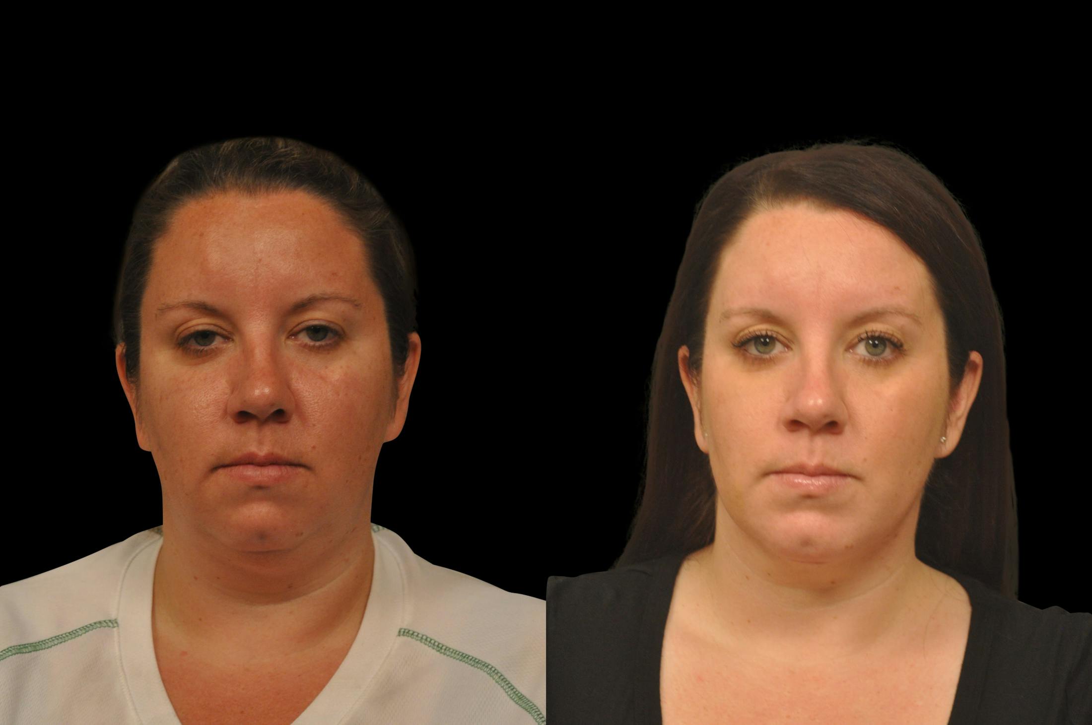 Neck Lift Before & After Gallery - Patient 601822 - Image 5
