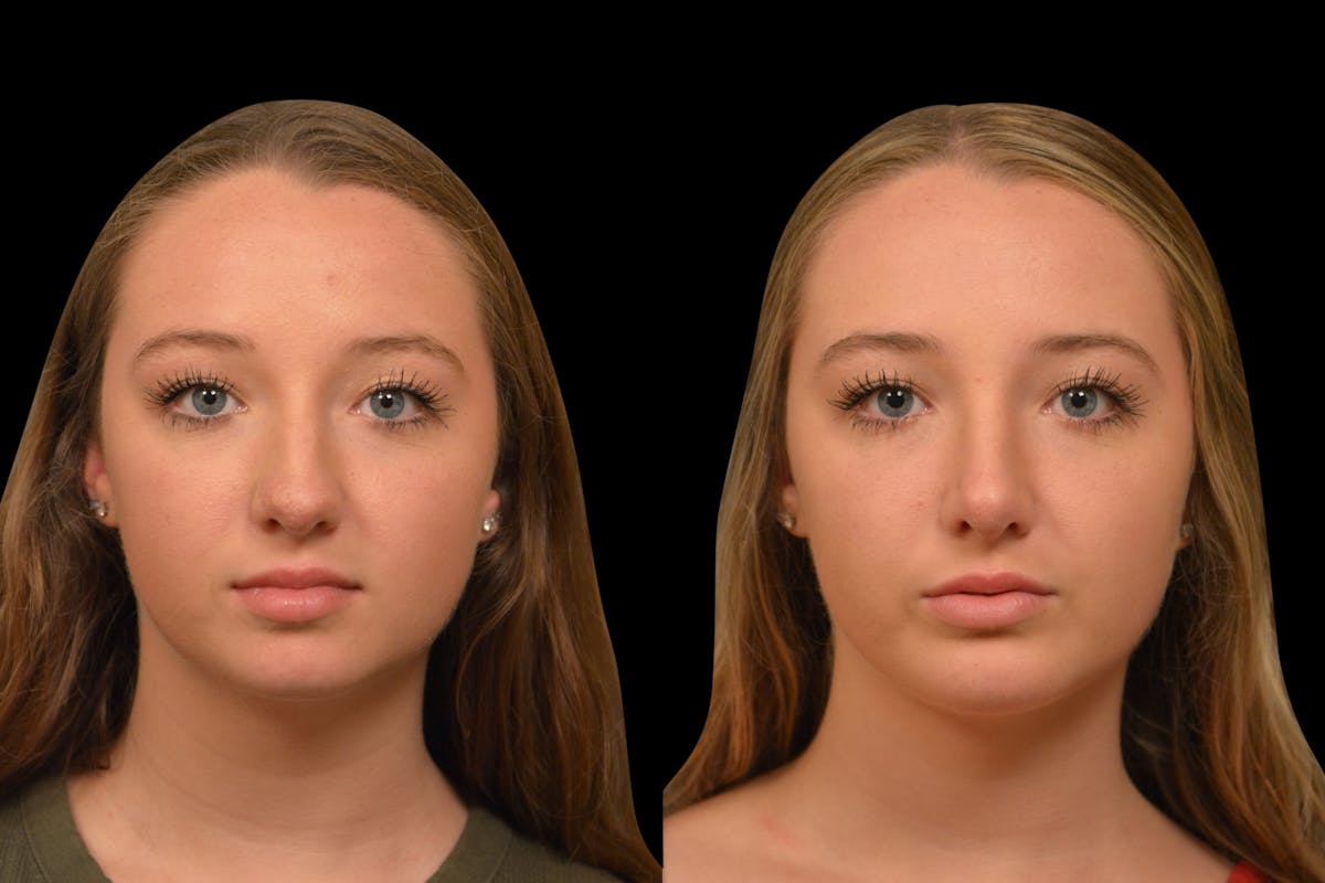 Rhinoplasty Before & After Gallery - Patient 139115 - Image 6