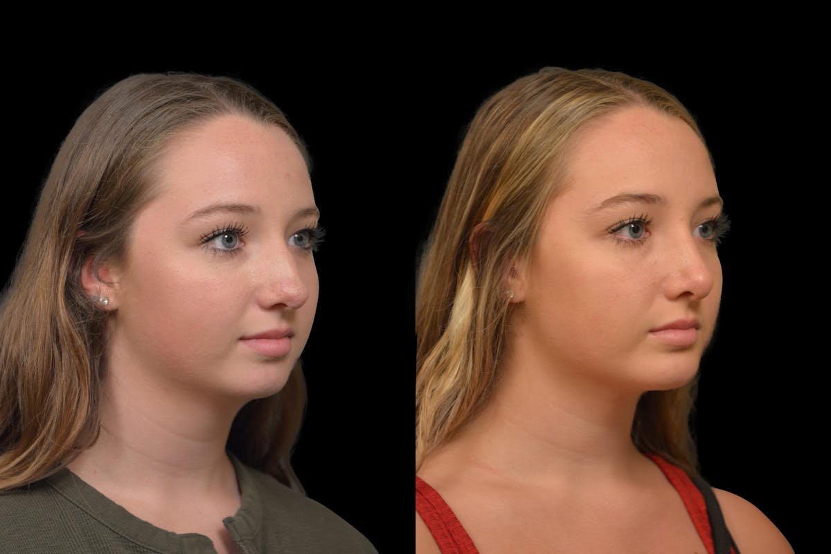 Chin Augmentation Before & After Gallery - Patient 304494 - Image 3