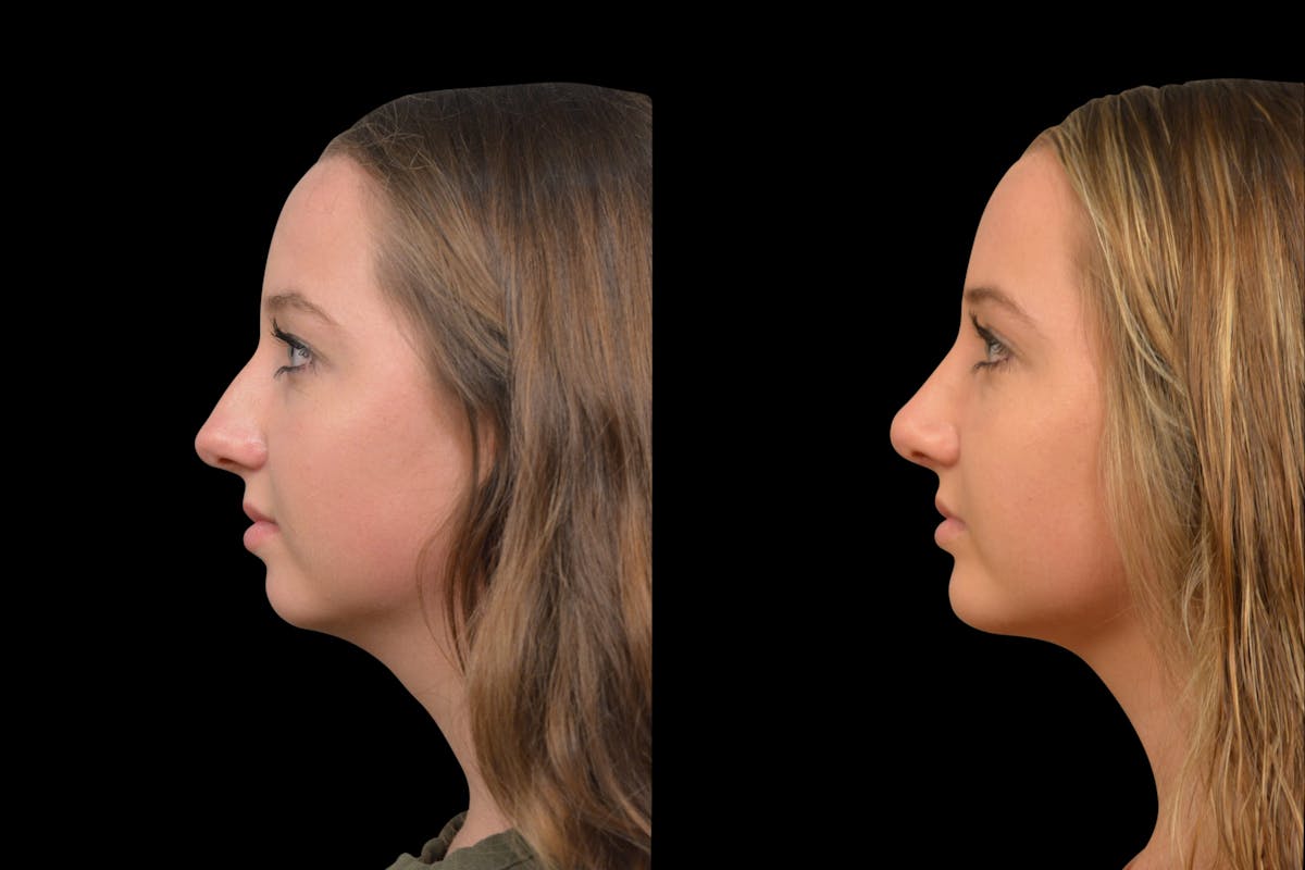 Chin Augmentation Before & After Gallery - Patient 304494 - Image 4