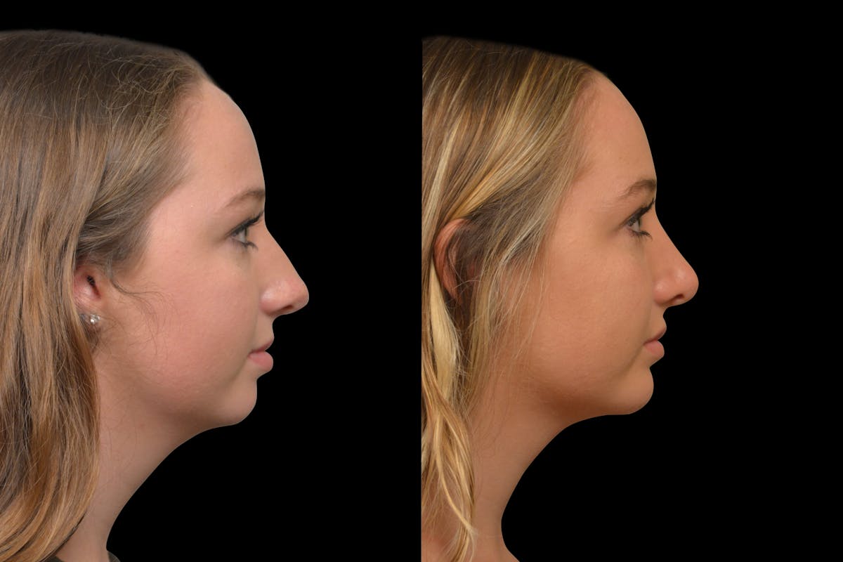 Chin Augmentation Before & After Gallery - Patient 304494 - Image 5