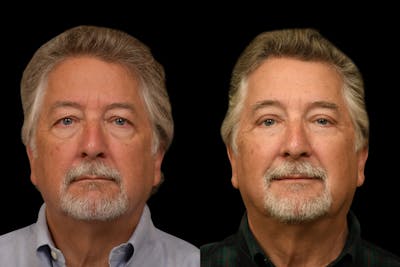 Eyelid Procedures Before & After Gallery - Patient 321587 - Image 1