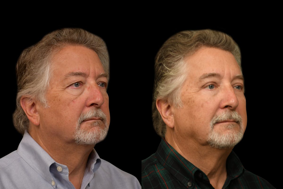 Eyelid Procedures Before & After Gallery - Patient 321587 - Image 2