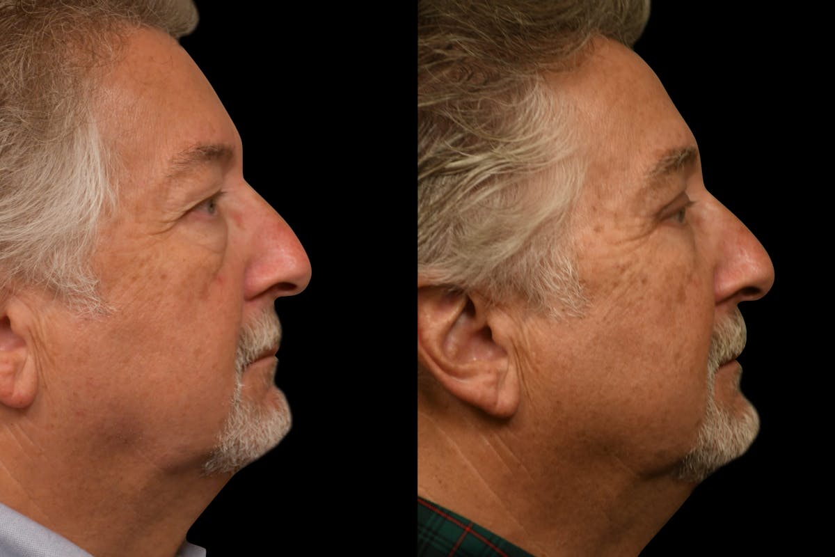 Eyelid Procedures Before & After Gallery - Patient 321587 - Image 4