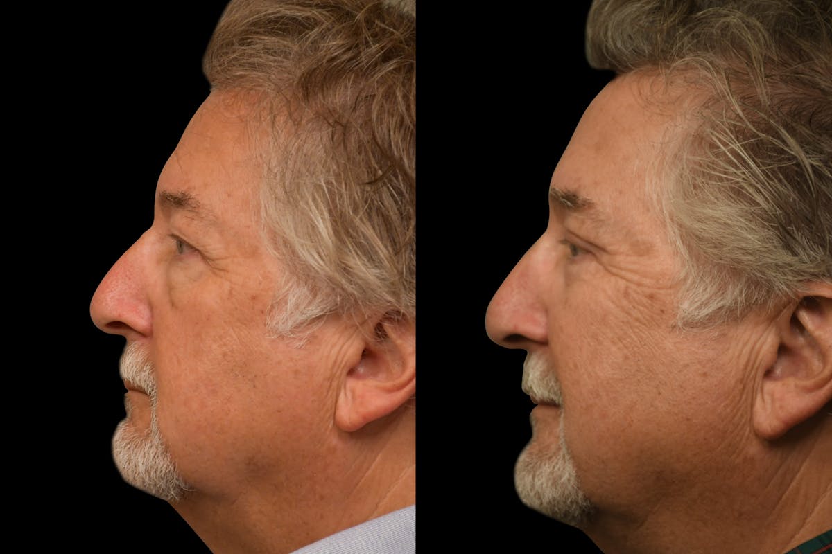 Eyelid Procedures Before & After Gallery - Patient 321587 - Image 5