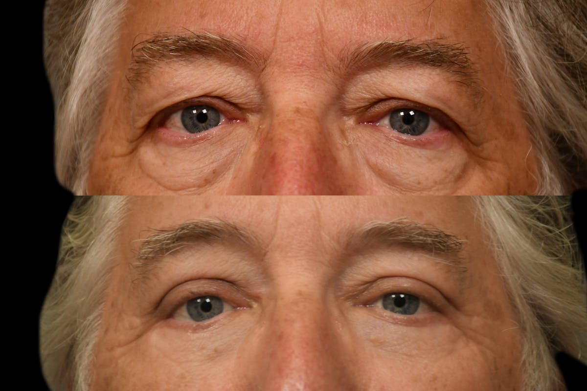 Eyelid Procedures Before & After Gallery - Patient 321587 - Image 6