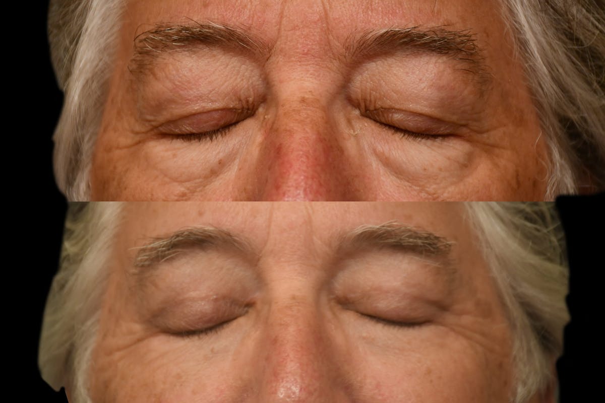 Eyelid Procedures Before & After Gallery - Patient 321587 - Image 7