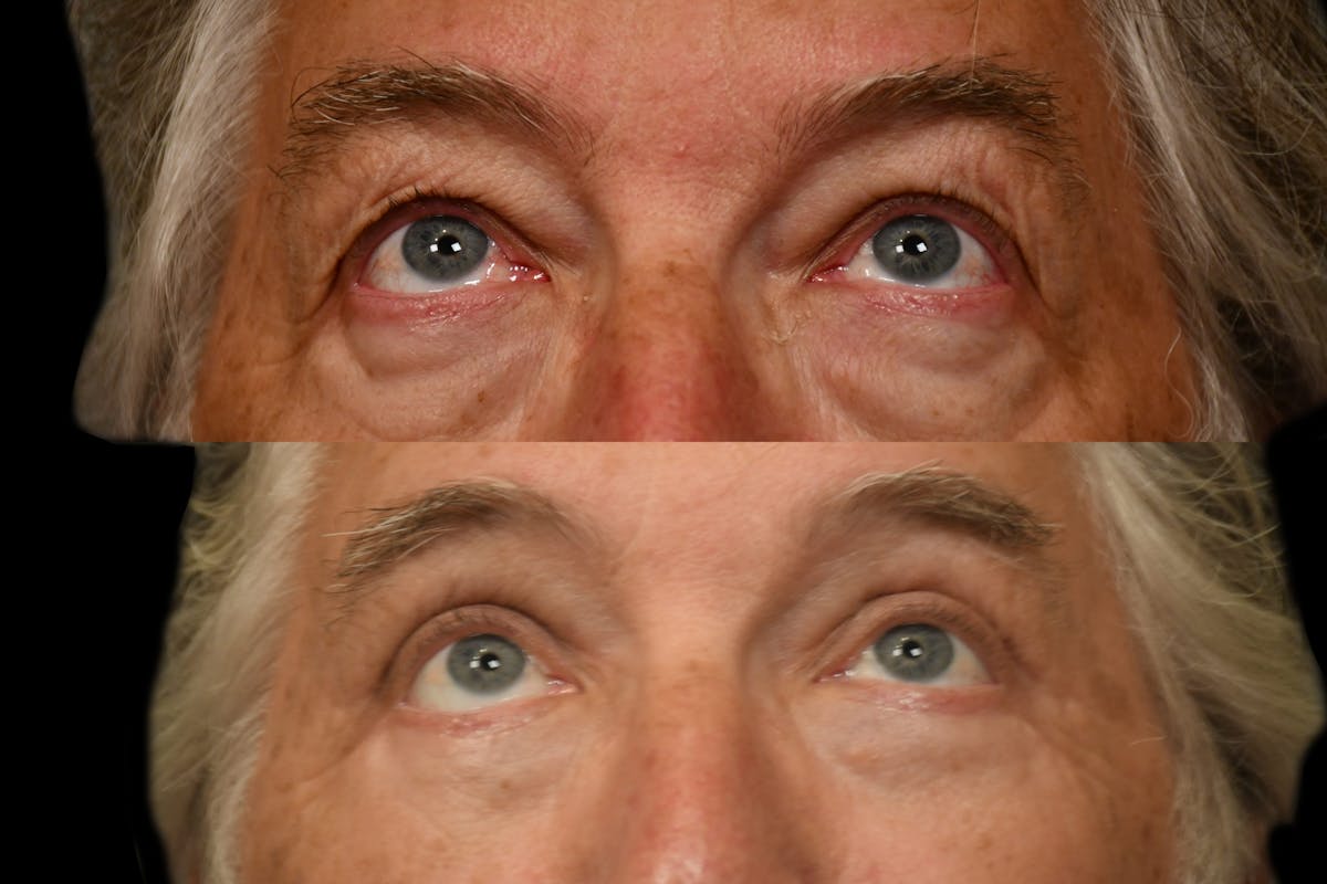 Eyelid Procedures Before & After Gallery - Patient 321587 - Image 8