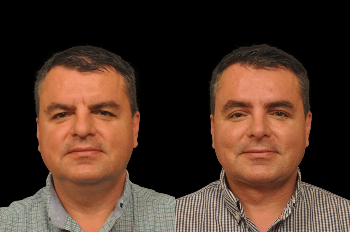 Neck Lift Before & After Gallery - Patient 117380 - Image 5