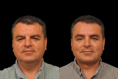 Eyelid Procedures Before & After Gallery - Patient 110632 - Image 1