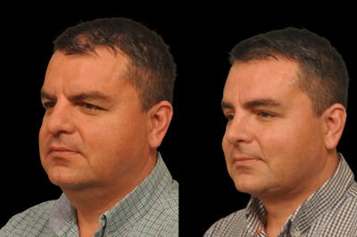 Neck Lift Before & After Gallery - Patient 117380 - Image 1