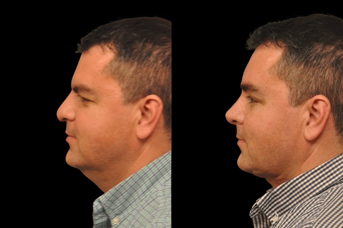 Neck Lift Before & After Gallery - Patient 117380 - Image 2