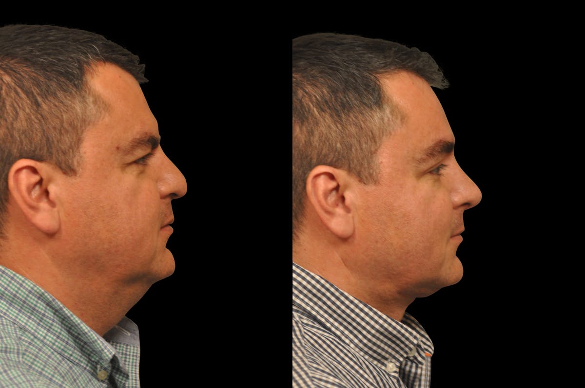 Neck Lift Before & After Gallery - Patient 117380 - Image 4