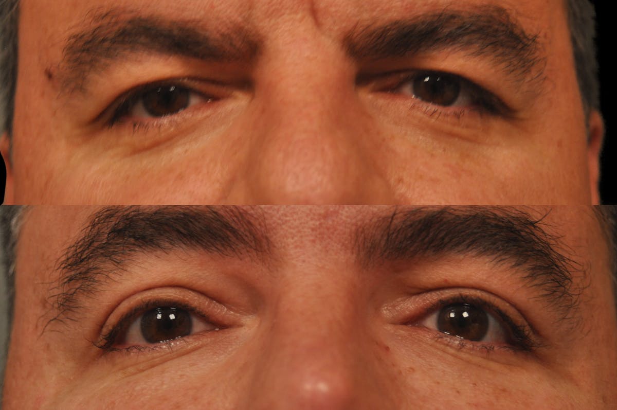 Eyelid Procedures Before & After Gallery - Patient 110632 - Image 6