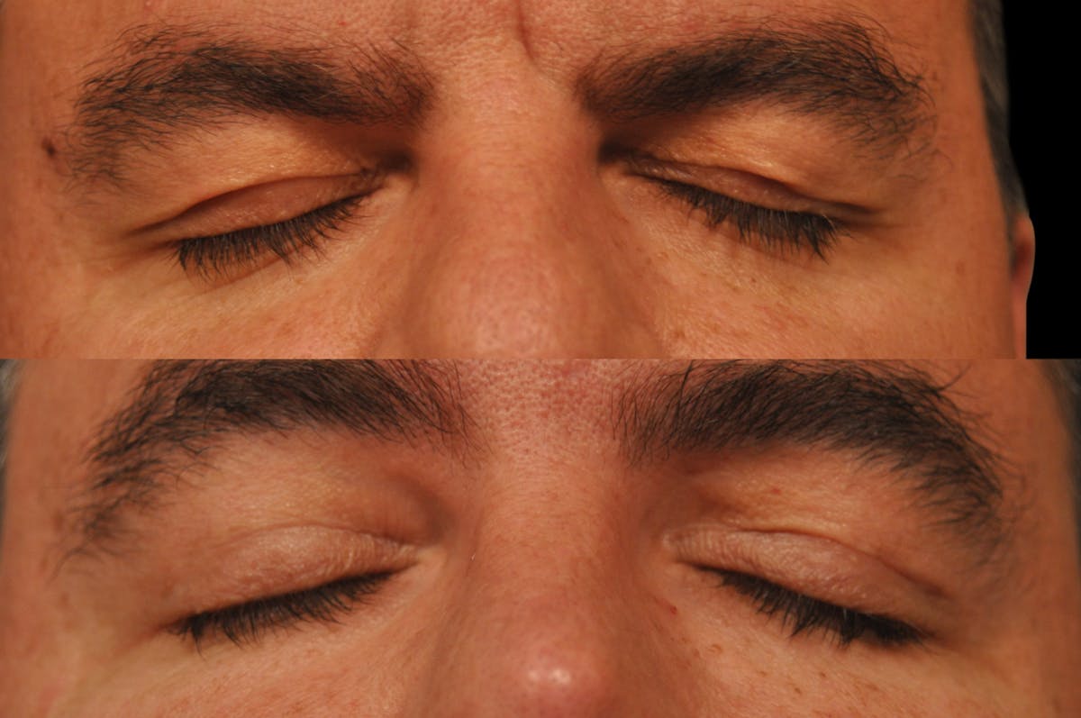 Eyelid Procedures Before & After Gallery - Patient 110632 - Image 7