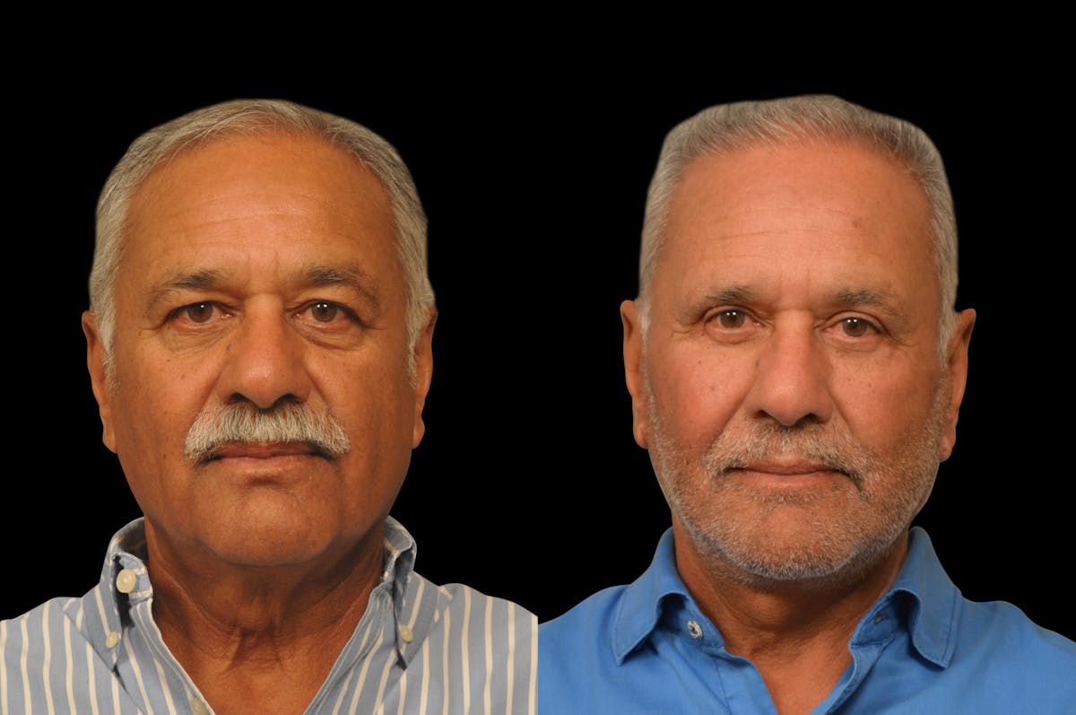 Changes Rapid Lift For Men Before & After Gallery - Patient 300955 - Image 5