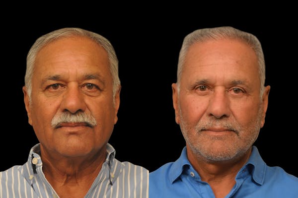 Eyelid Procedures Before & After Gallery - Patient 374701 - Image 1