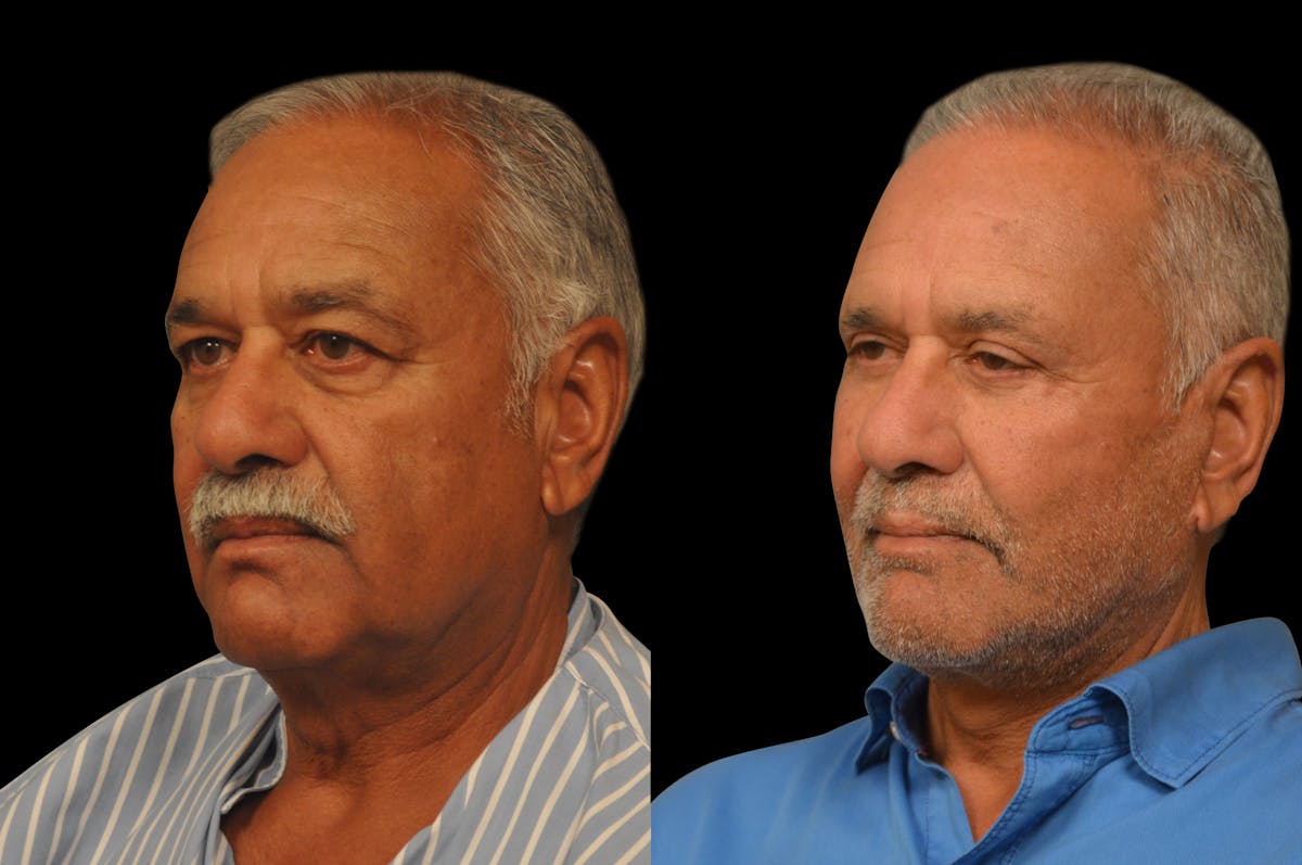 Changes Rapid Lift For Men Before & After Gallery - Patient 300955 - Image 1